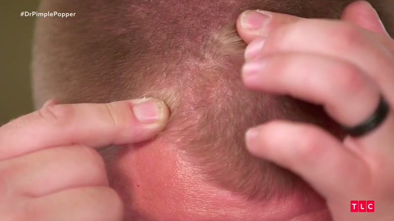 Illustration for article titled Dr. Pimple Popper Removes 68 Lipomas from One Person in Season 2 Premiere